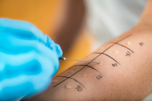 What You Need To Know About Skin Allergy Tests