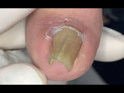 How to repair curved nails